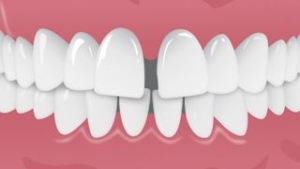 空隙歯列（歯と歯の間に隙間がある）